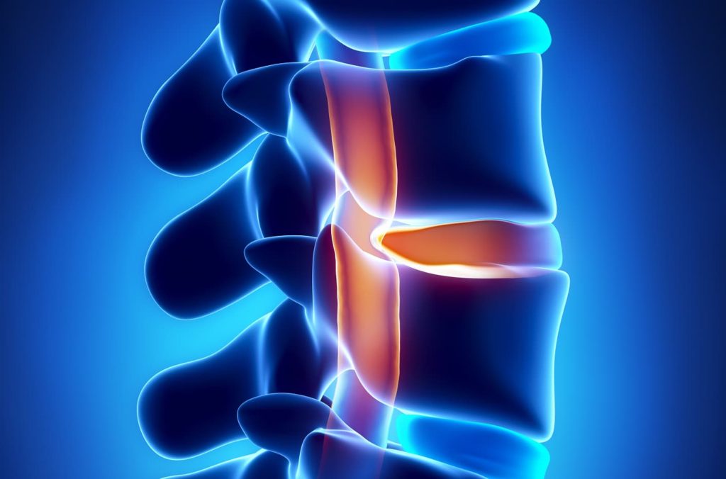 Chiropractic Care for Herniated disc